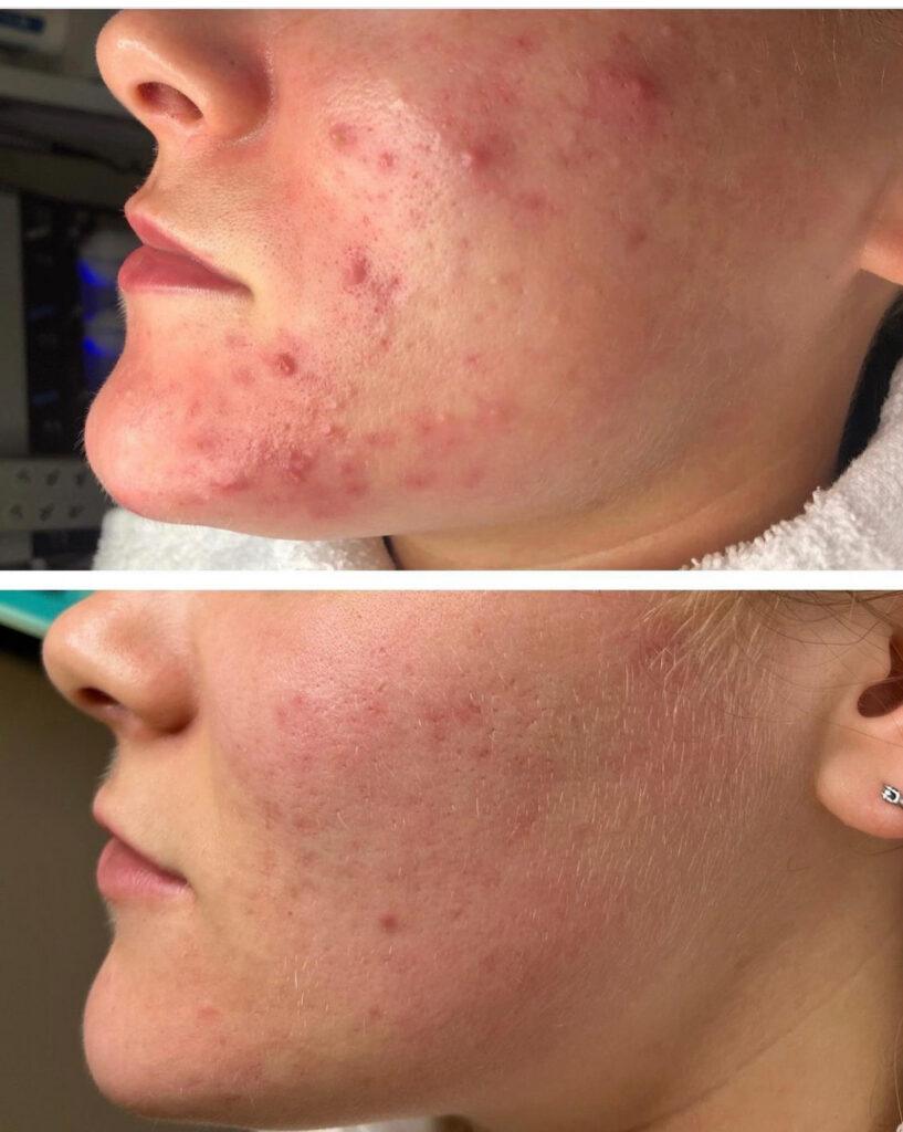 Before-and-after photo showing clearer, smoother facial skin after laser hair removal for acne-prone skin