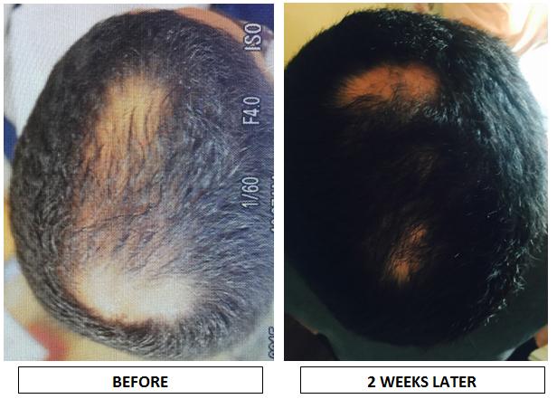 Before-and-after photos of the scalp showing significant hair thinning initially and fuller-looking coverage two weeks later.