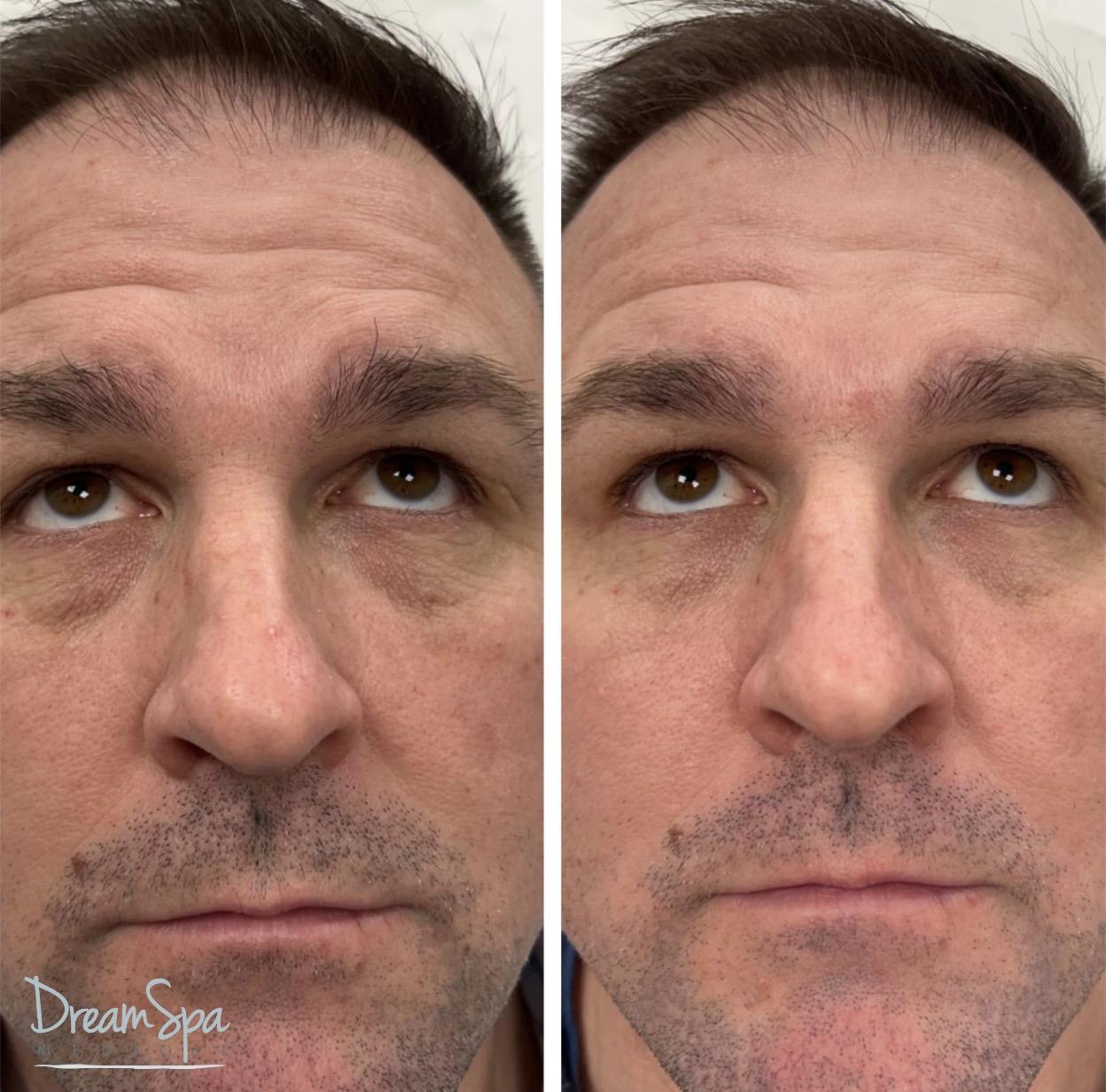 PRP Under-Eye Treatment