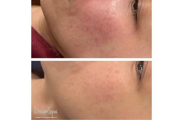IPL - Rosacea Treatment at Dream Spa Medical